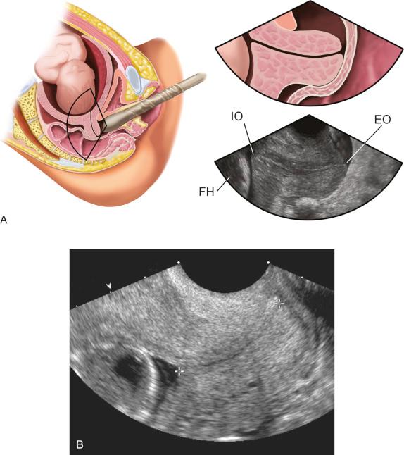 FIG 18-2, A, Diagrams and sonogram of the female pelvis demonstrating placement of the ultrasound transducer for transvaginal imaging of the gravid cervix. EO, external os; FH, fetal head; IO, internal os. B, Two-dimensional ultrasound image of the cervix in its longest axis in the sagittal view. The internal and external os ( calipers ) and the entire endocervical canal can be clearly seen, and the image is enlarged so that it occupies more than 75% of the screen.