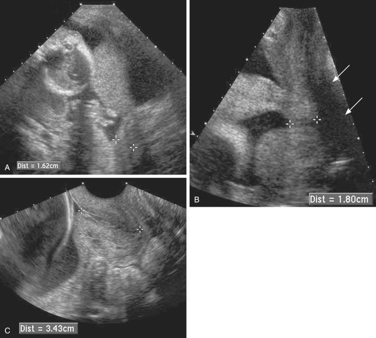 FIG 18-3, Three methods of imaging the cervix. A, Transabdominal sonogram. The cervix, which is distant from the ultrasound transducer, is poorly seen and appears to measure 1.62 cm in length ( calipers ). B, Translabial sonogram in the same patient. With this approach, visualization of the cervix is somewhat clearer, but shadowing from air in the rectum ( arrows ) partially obscures the view, resulting in undermeasurement of the cervical length ( calipers ). C, Transvaginal sonogram. The cervix is well seen and measures 3.43 cm in length ( calipers ).