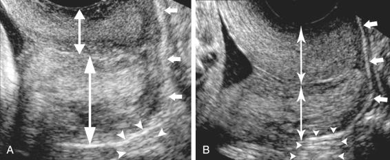 FIG 18-4, A, Ultrasound image of the cervix with excess manual pressure from the transvaginal probe. The anterior lip of the cervix appears significantly thinner than the posterior lip of the cervix ( double-headed arrows ). Small triangular markers ( arrowheads ) show increased echogenicity below the posterior lip of the cervix, an indication of excess pressure. B, The anterior and posterior portions of the cervix appear equal in thickness ( double-headed arrows ). The transvaginal transducer should be inserted just enough to adequately visualize and obtain a reliable measurement of cervical length, without altering anatomy. Vaginal mucosa appears hyperechoic ( small short arrows ).