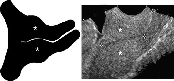 FIG 18-5, Cervix with lower uterine segment contractions ( asterisks ). Lower uterine segment contractions should be considered whenever the apparent cervical length (CL) measures more than 50 mm, the cervical canal assumes an S shape, or the lower uterine segments (either anteriorly, posteriorly, or both) appear thickened and asymmetric. Lower uterine segment contractions can distort the landmarks of the cervix resulting in inaccurate CL measurement.