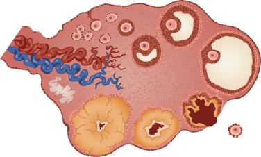 FIG 30-1, Diagram demonstrating a normal ovary with follicles in various stages of development, from early follicles in the follicular phase of development, through ovulation and subsequent development of the corpus luteum.
