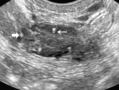 FIG 30-2, Tiny echogenic foci in the ovary. A 53-year-old postmenopausal patient with several tiny peripheral echogenic foci in each ovary, some with associated comet-tail artifact ( thin arrow ) and some with no distal artifact ( thick arrow ).