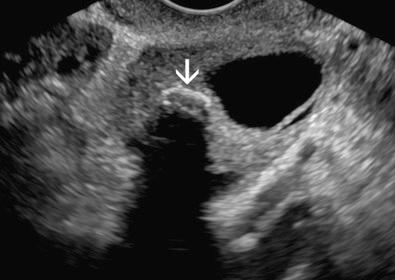 FIG 30-3, Ovarian calcification. A 9-mm calcification ( arrow ), with posterior acoustic shadowing, is shown within an otherwise normal-appearing ovary. Such calcifications are generally of no clinical significance, but may be followed sonographically.