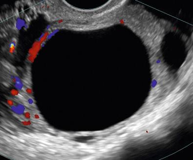 FIG 30-4, Simple ovarian cyst. Color Doppler ultrasound image of a simple ovarian cyst demonstrates the characteristic findings of anechoic contents, smooth thin wall, no internal vascularity, and posterior acoustic enhancement.