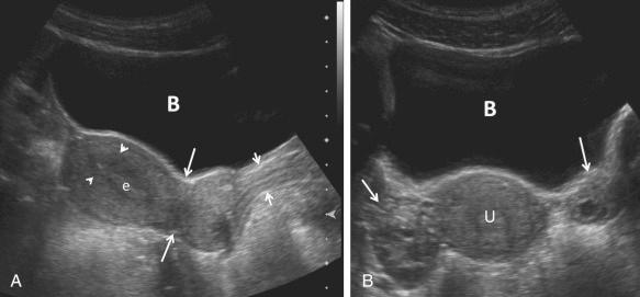 FIG 28-1, Transabdominal gray-scale ultrasound images of the normal uterus. A, Sagittal imaging plane. Note indentation below the lower uterine segment indicating the level of the internal os ( long arrows ), the striated appearance of the vagina ( short arrows ), the linear homogeneously echogenic endometrium (e), and the surrounding hypoechoic subendometrial halo ( arrowheads ). Note the acoustic window provided by the distended urinary bladder (B). B, Transverse imaging plane. Note the bladder (B), right and left ovaries ( arrows ), and uterus (U).