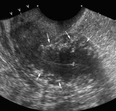 FIG 28-12, Transvaginal sagittal view of small retroverted and retroflexed uterus in a postmenopausal woman demonstrating arcuate artery calcifications ( arrows ). Calipers show the endometrium.