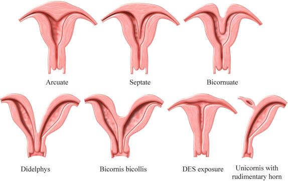 FIG 28-13, Most common uterine anomalies. DES, diethylstilbestrol.
