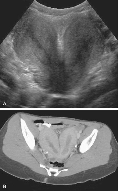 FIG 28-14, A, Coronal transvaginal view of a didelphys uterus with completely separate right and left cavities and deep intervening cleft between the two horns. B, Axial computed tomography scan of the same patient demonstrating a uterine didelphys with widely splayed uterine horns.