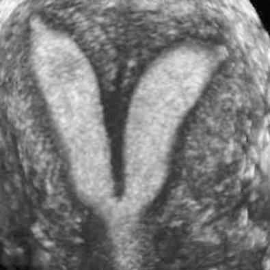 FIG 28-16, Coronal three-dimensional image of a septate uterus. Note two separate, but close endometrial cavities, thin hypoechoic septum extending to the level of the internal os, and smooth convex fundal contour without indentation between the two horns.