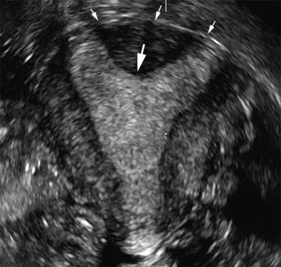 FIG 28-17, Coronal three-dimensional image of an arcuate uterus with a small myometrial indentation into the fundal aspect of the endometrium ( large arrow ). The outer serosal contour of the uterus is smooth and outwardly convex ( small arrows ).