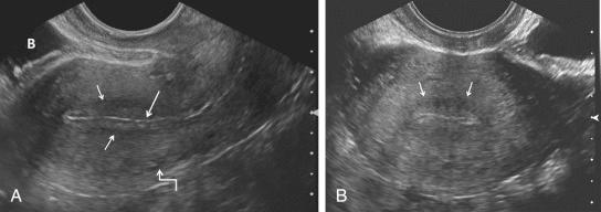 FIG 28-2, Transvaginal gray-scale ultrasound images of the normal uterus. A, Sagittal imaging plane. Note thin brightly echogenic line ( long arrow ) representing artifact or mucus between the echogenic anterior and posterior layers of the endometrium and the subjacent hypoechoic subendometrial halo ( short arrows ). The anechoic tubular arcuate vessels separating the outer from the intermediate layer of the myometrium are faintly visualized ( crooked arrow ). B, bladder. B, Transverse imaging plane. The hypoechoic subendometrial halo ( arrows ) can be seen surrounding the echogenic endometrium. Note significantly improved resolution and visualization of the normal zonal anatomy in these higher frequency transvaginal images in comparison to the lower frequency transabdominal images ( Fig. 28-1 ). However, the transabdominal images have a larger field of view, providing a better overview of pelvic structures.