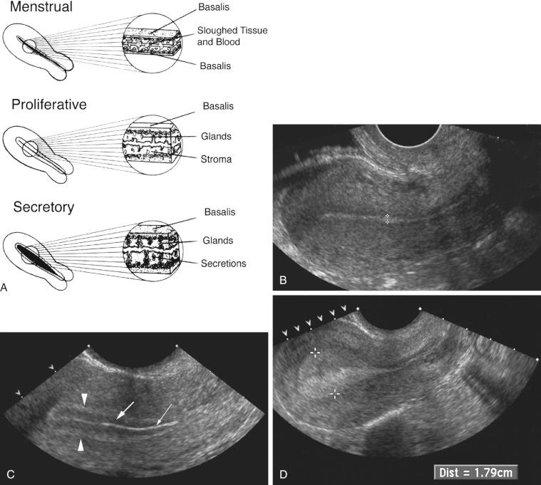 FIG 28-3, A, Diagram depicting normal development of the endometrium during the menstrual, proliferative, and secretory phases. In the menstrual phase, the endometrium appears as a thin, irregular interface. The central echogenicity probably arises from sloughed tissue and blood. In the proliferative phase, the endometrium is relatively hypoechoic, likely a reflection of the straight and orderly arrangement of the glandular elements. The central thin, echogenic line is likely a specular reflection from the endometrial surfaces. In the secretory phase, the endometrium achieves its maximum thickness and echogenicity. This appearance is from the distended and tortuous glands, which contain secretions. B, Postmenstrual transvaginal sagittal image of the uterus demonstrating the normal thin homogeneously echogenic early proliferative endometrium ( calipers ). C, Transvaginal sagittal image of the periovulatory endometrium. A three-layered endometrium is seen, giving the endometrium a striated appearance: the collapsed endometrial lumen is demonstrated by the very thin central echogenic line ( thin arrow ). The surrounding hypoechoic layer representing the edematous functionalis endometrium ( thick arrow ) and an outer hyperechoic layer representing the basal endometrium ( arrowheads ) are seen. D, Transvaginal sagittal image of the secretory endometrium. In the secretory stage of the menstrual cycle, the endometrium ( calipers ) becomes thick and more homogeneously echogenic.