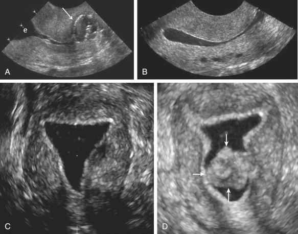 FIG 28-4, Saline-infused sonohysterogram. A, Transvaginal sagittal image of the cervix demonstrating the catheter balloon ( arrow ) positioned in the lower endocervical canal. Anechoic fluid is in the upper endocervical canal and lower endometrial cavity (e). B, Transvaginal sagittal image after saline infusion. The normal thin echogenic endometrium is well seen circumferentially. The endometrial cavity is filled with anechoic fluid. Note several small, round anechoic structures in a linear configuration in the posterior wall of the myometrium. These are the arcuate vessels and would fill in with color Doppler. C, A coronal three-dimensional reconstruction after saline infusion, demonstrating the normal regular, thin, echogenic endometrium without any intracavitary abnormalities. D, In comparison, a coronal three-dimensional reconstruction after saline infusion revealed a 100% intracavitary leiomyoma ( arrows ), separate from the thin, regular echogenic endometrium.