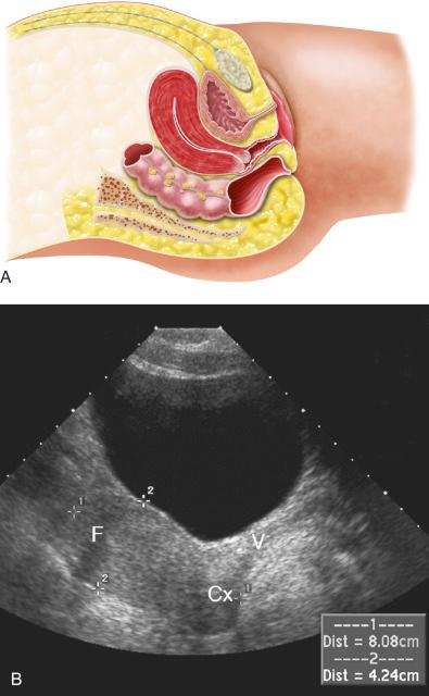 FIG 28-5, A, Illustration demonstrating an anteflexed, anteverted normal uterus. The cervix is pointing slightly more posterior in relationship to the vagina, and the fundus is flexed anterior in relation to the cervix. B, Midline sagittal sonogram demonstrating anteversion of the cervix (Cx) to the vagina (V). A distended urinary bladder slightly displaces the fundus (F) posteriorly. Standard measurements of the uterine size are made from fundus to cervix (calipers 1) and from anterior to posterior uterine wall (calipers 2) on sagittal transabdominal view.