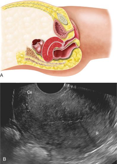 FIG 28-6, A, Illustration demonstrating a retroflexed uterus. The cervix is in conventional position in relationship to the vagina. However, the uterine fundus is flexed posteriorly at the level of the internal os in relation to the cervix. B, Midline sagittal transvaginal sonogram demonstrating uterine retroflexion. Uterine fundus (F) is positioned posterior and retroflexed in relation to the cervix (Cx). Note angulation between the echogenic endocervical canal and thin echogenic endometrium (owing to the flexion).