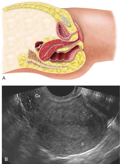 FIG 28-7, A, Illustration demonstrating a retroverted uterus; the cervix is angled slightly posterior in relation to the vagina, and the fundus is bent slightly posterior in relation to the cervix, indicating retroflexion as well. B, Midline sagittal transvaginal sonogram demonstrating posterior displacement of the fundus (F) and posterior angulation of the cervix (Cx).