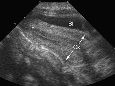 FIG 28-9, Transabdominal sagittal view of the normal prepubertal uterus. The cervix (Cx) is significantly more prominent than the body or fundus (F) of the uterus. Bl, bladder.