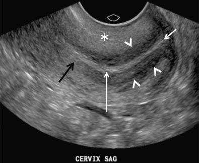 FIG 28-10, Normal sonographic zonal anatomy of the cervix. Note central linear echogenic endocervical canal ( long white arrow ), subjacent hypoechoic fibrous cervical stroma ( arrowheads ), outer muscular layer of intermediate echogenicity ( asterisk ), external os ( short white arrow ) between the lips of the cervix, and internal os ( black arrow ) at the level of narrowing or constriction between the body of the uterus and the cervix.