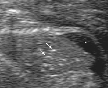 FIG 16-3, Sonogram of a second trimester fetus with proven cytomegalovirus infection. Hepatic calcifications ( arrows ) are seen as well as fetal ascites ( asterisk ).