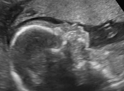 FIG 16-13, Profile of a fetus with nasal hypoplasia, as is seen with fetal warfarin syndrome.