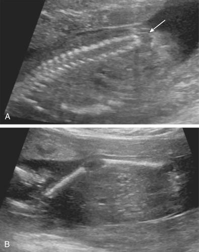 FIG 16-14, Caudal regression syndrome associated with poorly controlled maternal diabetes. A, Absent distal sacral spine ( arrow ); B, fixed extension of the lower extremity.