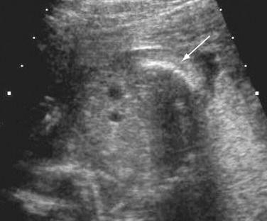 FIG 16-16, Caudal regression syndrome. The lack of sacrum allows the iliac wings to be approximated, giving them a shield-like appearance ( arrow ).