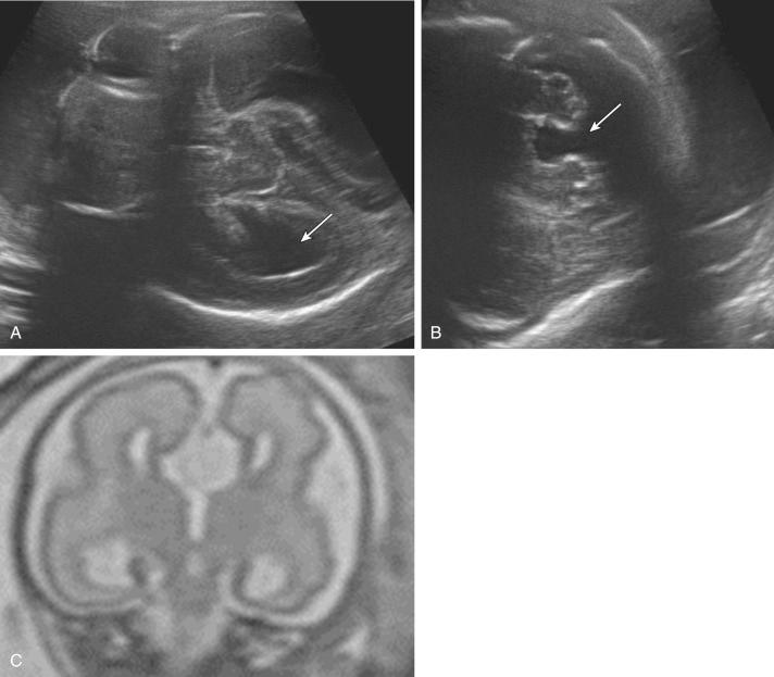 FIG 16-17, Aicardi syndrome. A, Ventriculomegaly; dilated lateral ventricle ( arrow ) is demonstrated in an axial image; B, Dandy-Walker malformation with agenesis of the cerebellar vermis ( arrow ); C, coronal magnetic resonance image of the fetal brain demonstrating agenesis of the corpus callosum and an interhemispheric cyst.