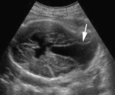 FIG 16-18, Meckel syndrome: occipital encephalocele ( arrow ).