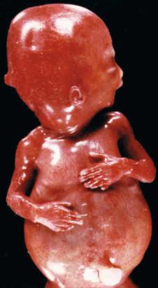 FIG 16-21, A fetus with Meckel syndrome. Note the small posterior encephalocele, the large abdominal distention due to the bilateral cystic kidneys, and the postaxial polydactyly.