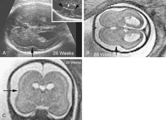 FIG 16-22, Abnormal sylvian fissure/insula at 26 weeks. A, Axial ultrasound image at 26 weeks in a fetus with lissencephaly associated with Miller-Dieker syndrome shows a shallow, flat sylvian fissure/insula ( arrow ) with absence of angularity at the insular margins. Inset shows the expected appearance of the sylvian fissure/insula in a 26-week normal fetus. Infolding of the operculum should be seen with acute angles ( black arrows in inset) at the margins of the insula ( white arrowhead in inset) at 24.5 weeks' gestation. Axial ( B ) and coronal ( C ) T2-weighted magnetic resonance images at 28 weeks in the same fetus with Miller-Dieker syndrome showing a shallow sylvian fissure ( arrow ). The brain has an hourglass or figure-of-eight appearance on the axial image. Also note the agyria, large subarachnoid space, and mildly dilated occipital horns.