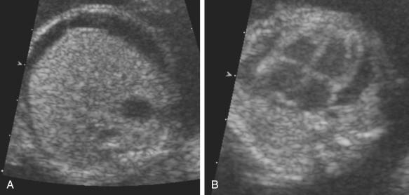 FIG 16-4, Parvovirus infection. Ascites ( A ) and pericardial effusions ( B ) in a fetus with anemia due to parvovirus infection. Fetal ascites is often the initial sonographic finding in parvovirus infection.