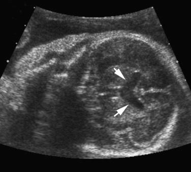 FIG 16-23, Second trimester sonogram of the fetal head in a patient with septo-optic dysplasia. Absence of the septum pellucidum and communication of the frontal horns of the lateral ventricles ( arrows ) is seen.