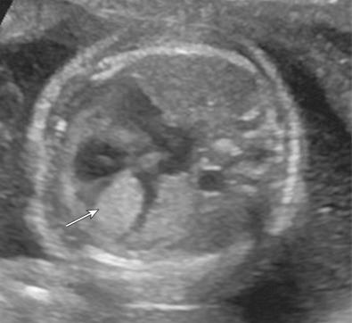 FIG 16-24, Tuberous sclerosis. Cardiac rhabdomyoma is demonstrated as a large, solid echogenic mass ( arrow ) in the left cardiac ventricle of this fetus with tuberous sclerosis.