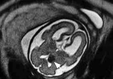 FIG 16-26, Axial view (T2-weighted) in a fetus of 26 weeks' gestation showing a typical subependymal nodule ( arrow ).