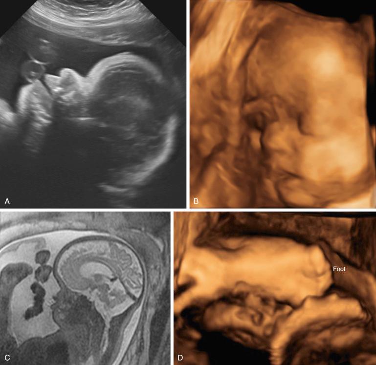 FIG 16-27, Apert syndrome. Ultrasound images demonstrating frontal bossing and midface hypoplasia on two-dimensional (2D) ( A ) and 3D ( B ) images, as well as by magnetic resonance imaging ( C ). Ultrasound image also demonstrated syndactyly of the foot ( D ), which is characteristic of Apert syndrome.