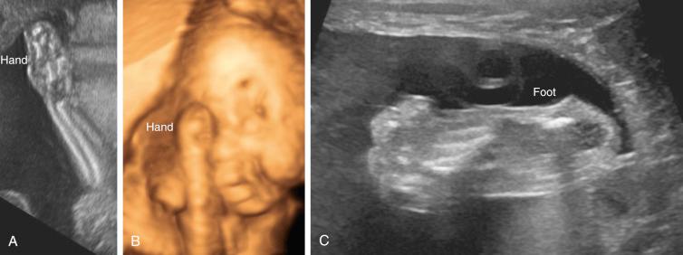 FIG 16-28, Apert syndrome. Syndactyly of the hand demonstrated with two-dimensional (2D) ( A ) and 3D ( B ) ultrasound images. Syndactyly of the foot is also present ( C ).