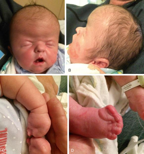 FIG 16-29, Newborn with Apert syndrome. Note appearance of the head, with frontal bossing ( A and B ), and syndactyly of the hand ( C ) and foot ( D ).