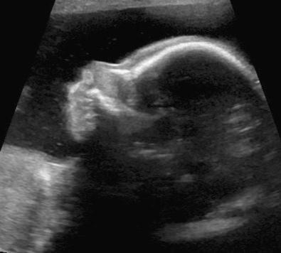 FIG 16-30, Micrognathia. Profile of a fetus shows mild micrognathia.