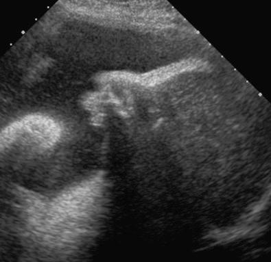 FIG 16-31, Severe micrognathia in a fetus with Nager syndrome. This can result in severe airway compromise at birth.