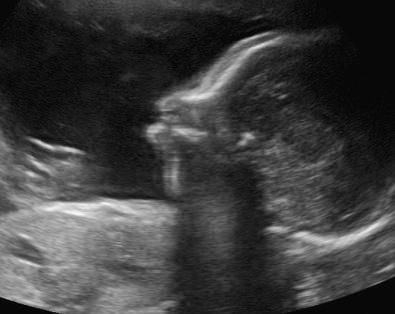 FIG 16-32, Micrognathia in a fetus with Pierre Robin sequence.