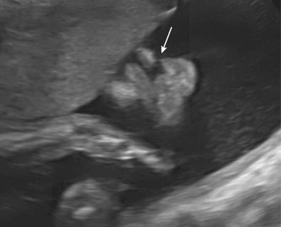 FIG 16-33, Coronal ultrasound image showing unilateral cleft lip ( arrow ) in a fetus with van der Woude syndrome.