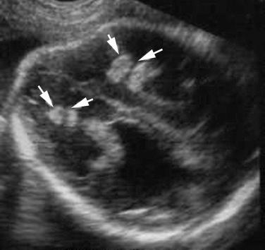 FIG 16-7, Toxoplasmosis. Intracranial calcifications ( arrows ) in a fetus with toxoplasmosis infection.