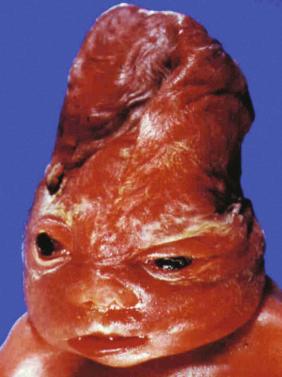 FIG 16-8, Varicella zoster infection. The fetal face at autopsy (26 weeks). Note the collapsed cranium, intact skin (very little maceration), disproportionate necrosis of the ocular globes, and flattened midface.