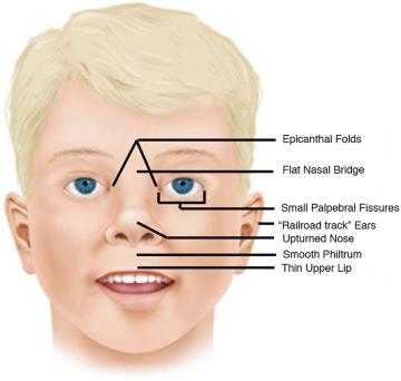 FIG 16-9, Characteristic facial features in a child with fetal alcohol spectrum disorders. Findings may include a smooth philtrum, thin upper lip, upturned nose, flat nasal bridge and midface, epicanthal folds, small palpebral fissures, and small head circumference.