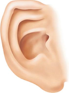 FIG 16-10, Characteristic features of an ear of a child with fetal alcohol spectrum disorders. Note the underdeveloped upper part of the ear parallel to the ear crease below (“railroad track” appearance).