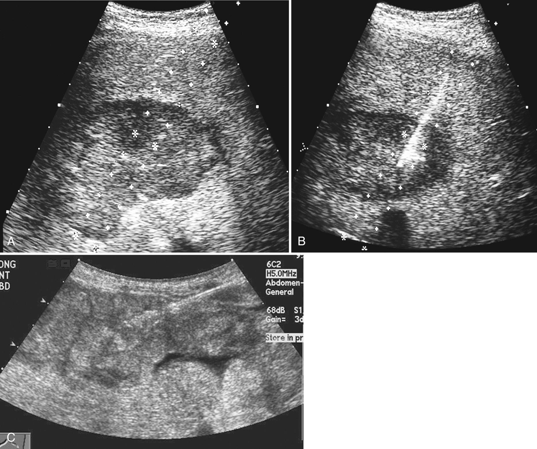 FIG. 17.1, Ultrasound-Guided Biopsy With and Without Needle Guide.