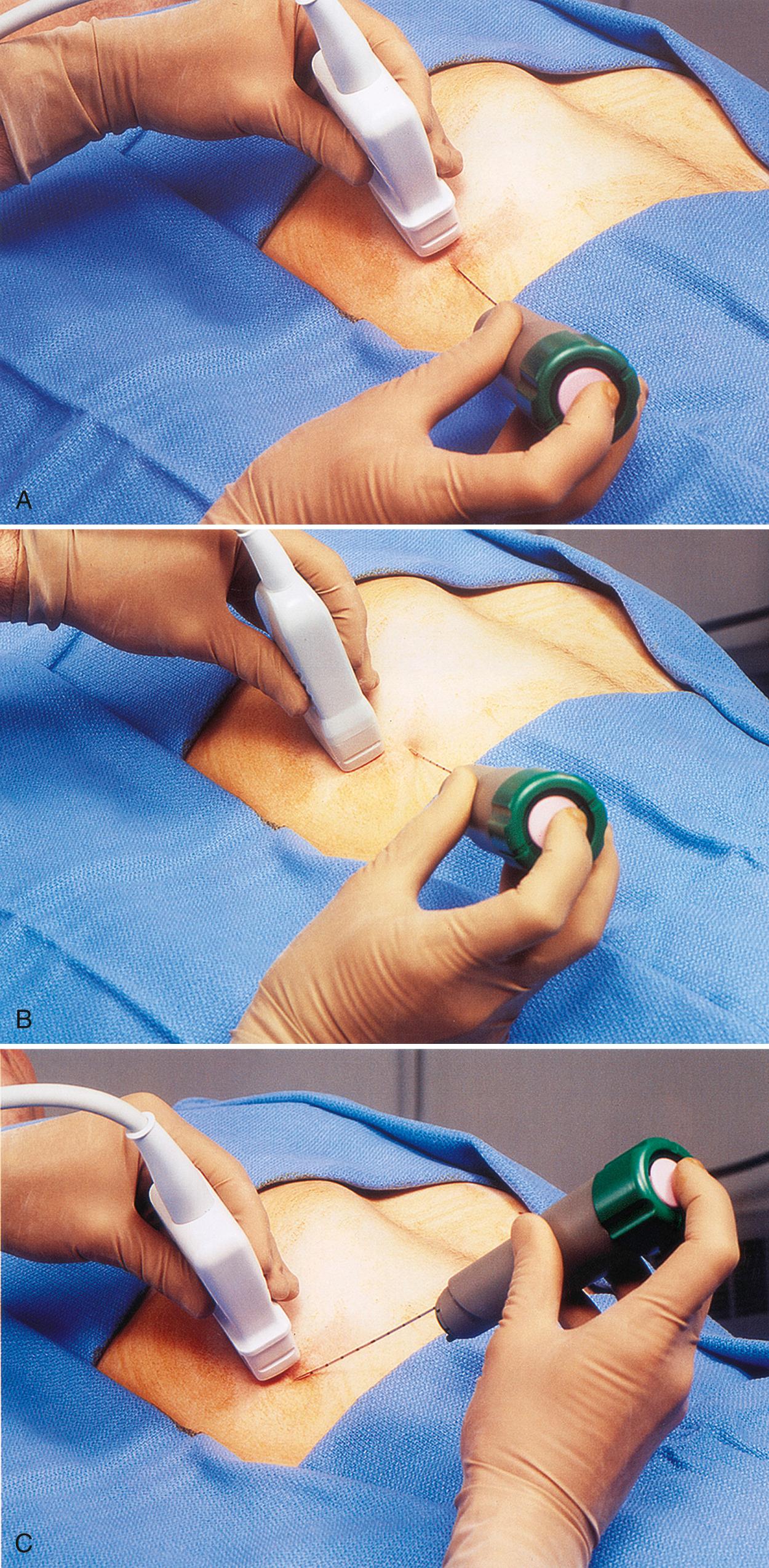 FIG. 17.3, Freehand Alignment of Biopsy Needle With Ultrasound Transducer.