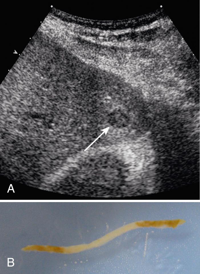 FIG. 17.4, Ultrasound-Guided Biopsy of Small Hepatic Metastasis.