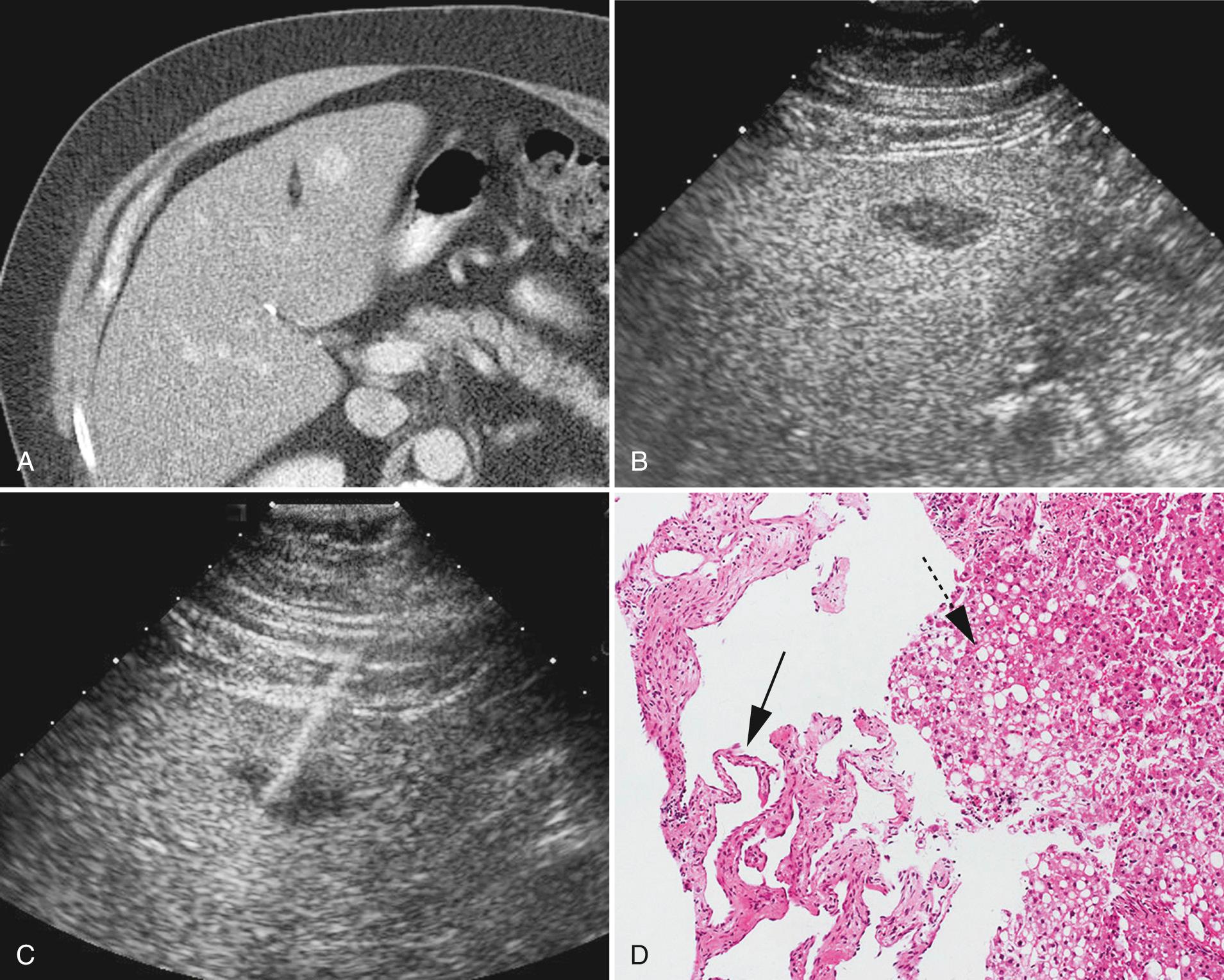 FIG. 17.5, Biopsy of Cavernous Hemangioma.