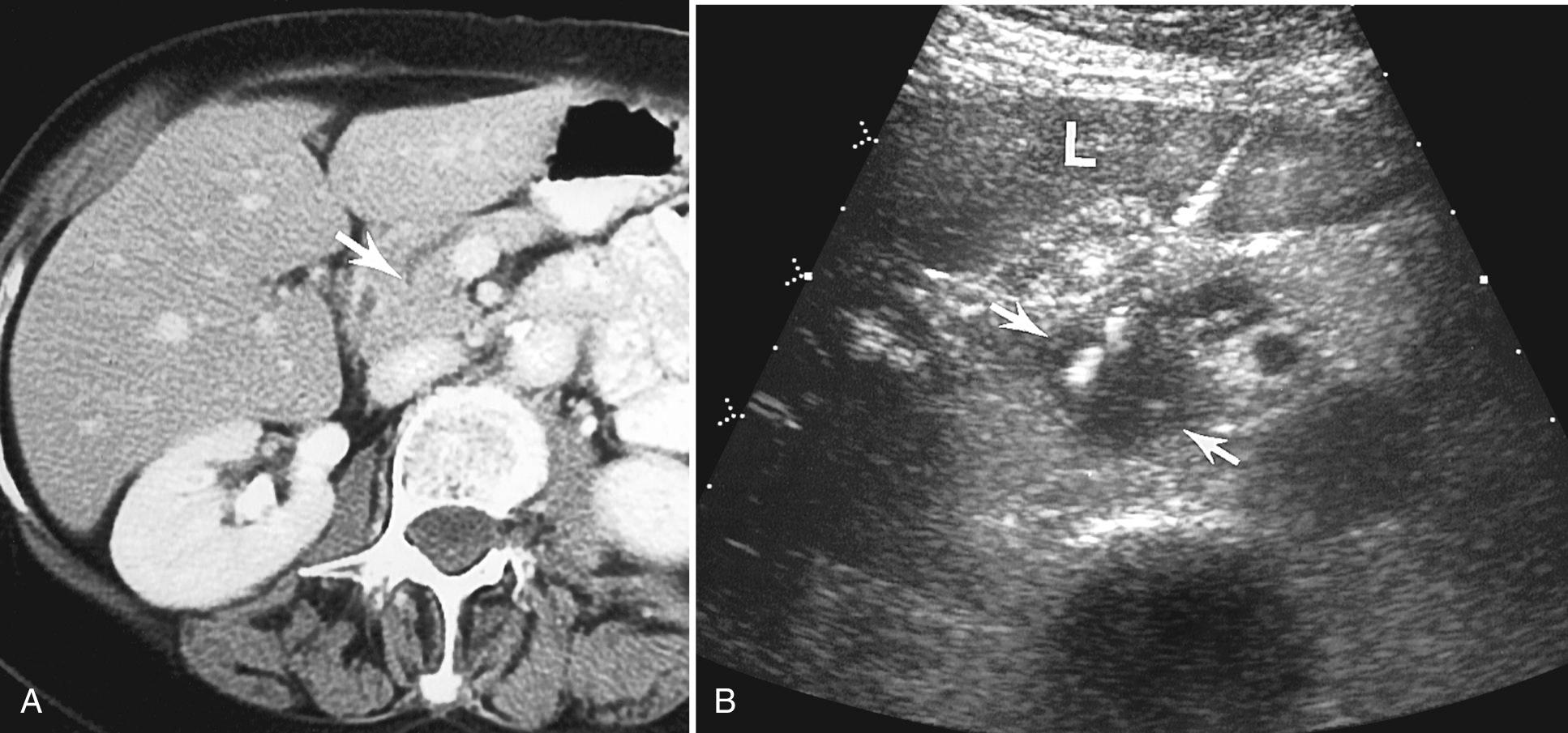 FIG. 17.6, Ultrasound-Guided Pancreatic Biopsy.